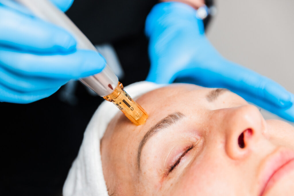 A patient receives microneedling as skin texture treatments in Denver, CO