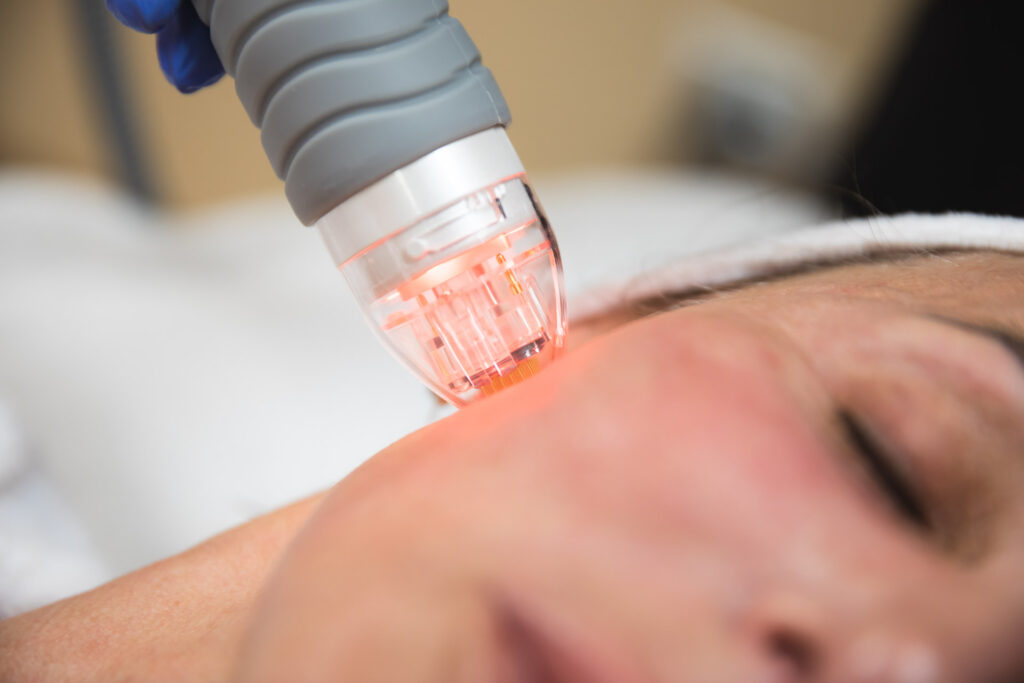 A patient receives RF microneedling for dry skin treatments in Denver, CO