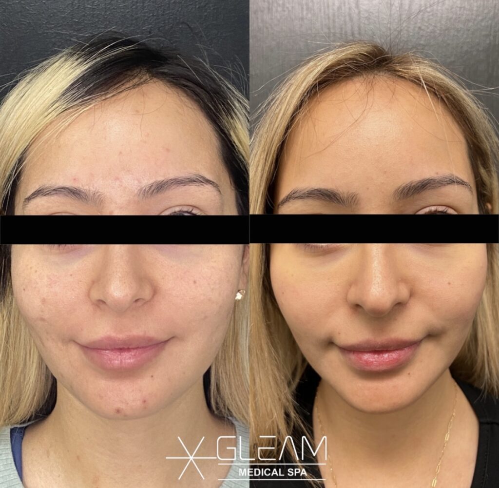 A female patient before and after a HydraFacial in Denver, CO